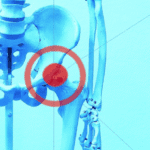 Modelo óseo de pelvis y fémures con la articulación de la cadera derecha resaltada por un círculo rojo sobre fondo azul.