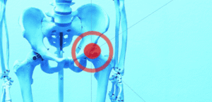 Modelo óseo de pelvis y fémures con la articulación de la cadera derecha resaltada por un círculo rojo sobre fondo azul.