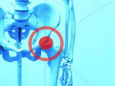 Modelo óseo de pelvis y fémures con la articulación de la cadera derecha resaltada por un círculo rojo sobre fondo azul.