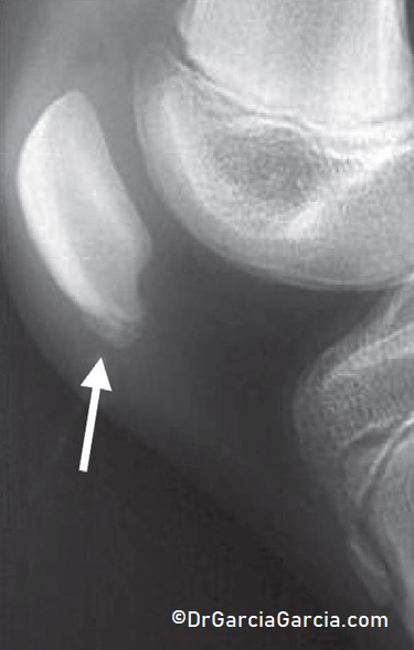 Figura 10. Radiografía de la rodilla de un niño con dolor en el polo rotuliano inferior. Corresponde a una osteocondrosis por una enfermedad de Sinding-Larsen-Johansson.