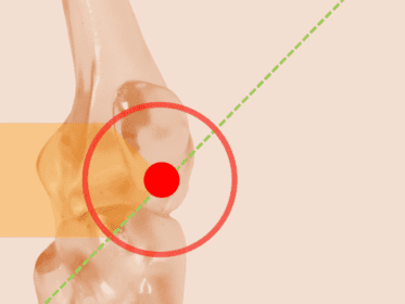 Imagen anatómica del codo humano con fondo beige, círculo rojo destacando la articulación y una línea diagonal verde que cruza la zona señalada.