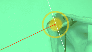 Imagen anatómica de un hombro humano con fondo verde, flecha roja apuntando a la articulación glenohumeral y líneas de referencia en blanco y amarillo.