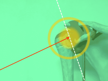 Imagen anatómica de un hombro humano con fondo verde, flecha roja apuntando a la articulación glenohumeral y líneas de referencia en blanco y amarillo.