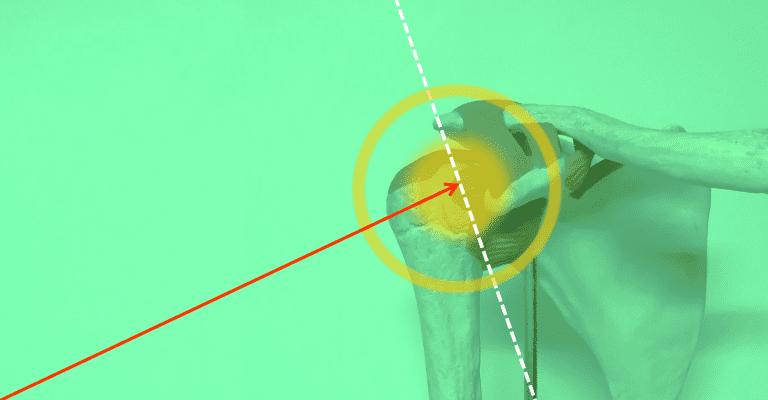 Imagen anatómica de un hombro humano con fondo verde, flecha roja apuntando a la articulación glenohumeral y líneas de referencia en blanco y amarillo.