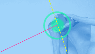 Imagen anatómica de una escápula y húmero con enfoque visual en la articulación del hombro, destacada por círculos verdes y líneas direccionales.