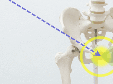 Modelo anatómico de pelvis con columna lumbar, mostrando una línea diagonal punteada hacia la articulación sacroilíaca derecha, destacada por un círculo amarillo y un foco luminoso, para explicar causas de dolor en la ingle mujer al caminar.