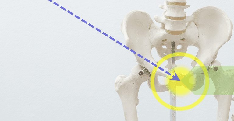 Modelo anatómico de pelvis con columna lumbar, mostrando una línea diagonal punteada hacia la articulación sacroilíaca derecha, destacada por un círculo amarillo y un foco luminoso, para explicar causas de dolor en la ingle mujer al caminar.