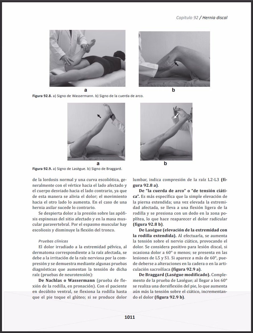 Hernia discal