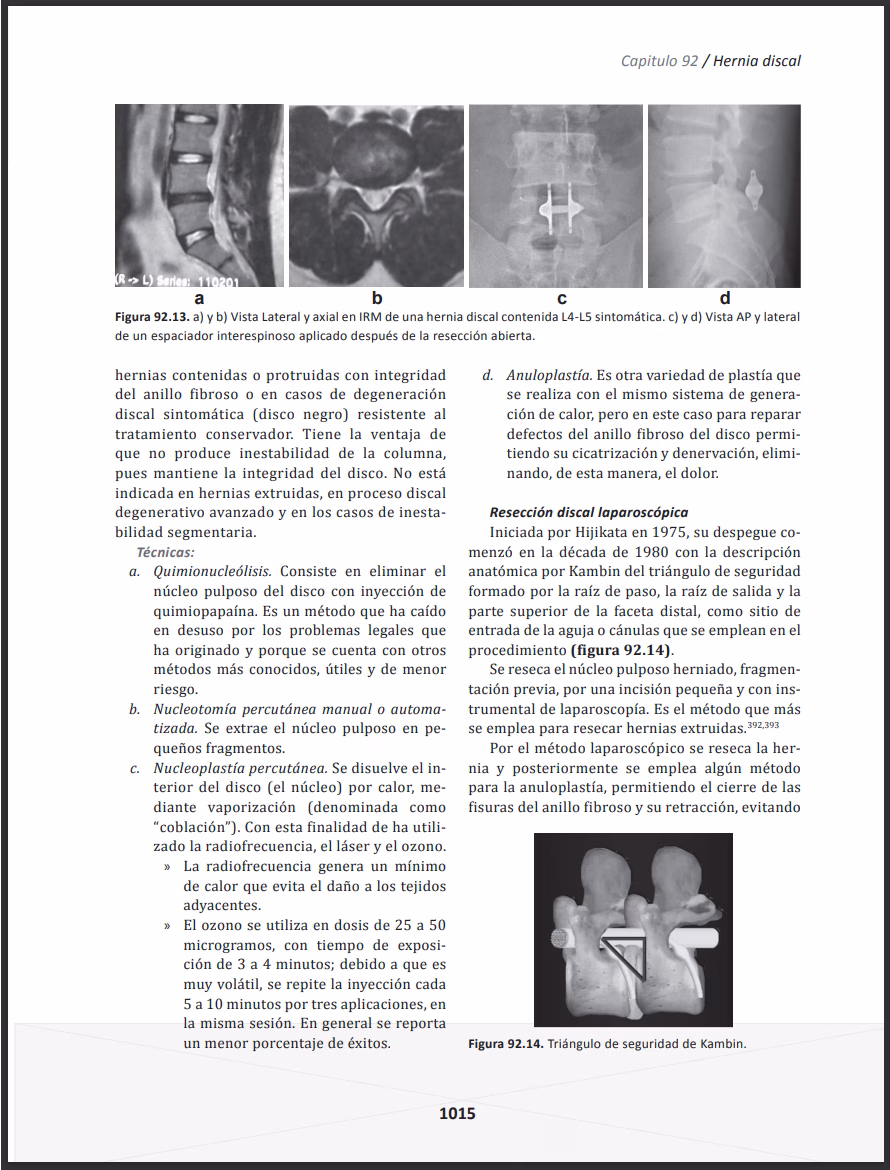 Tema sobre tratamiento de hernia discal