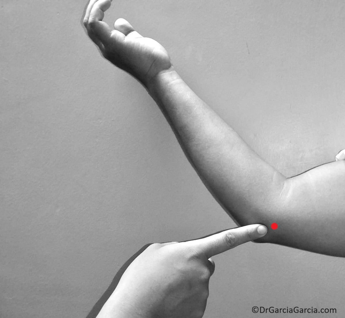 Figura 11. Zona de dolor en la epicondilosis medial