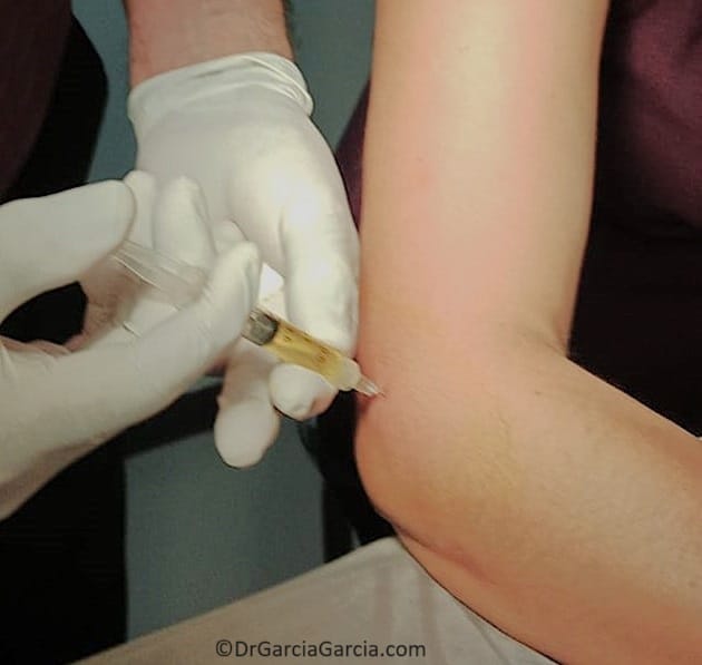 Figura 8. Aplicación de plasma rico en plaquetas