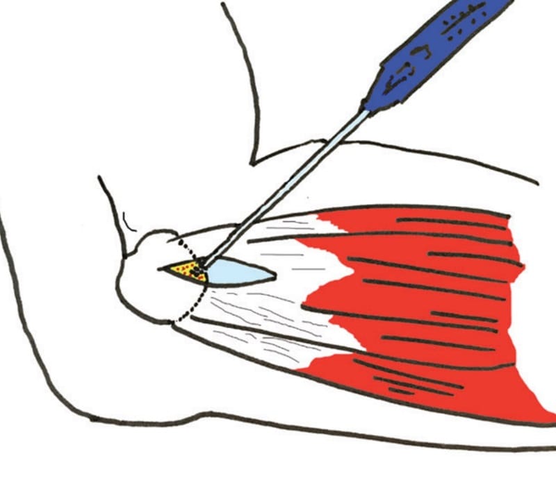 Figura 9. Tratamiento quirúrgico. Desbridamiento y decorticación del epicóndilo con técnica abierta.