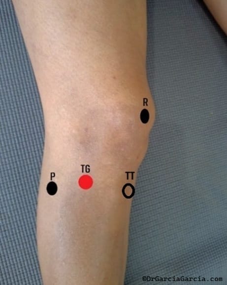 Rodilla derecha vista anterolateral externa, foto clínica
