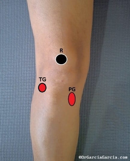 Rodilla vista clínica anterior; inserciones de banda iliotibial (TG) y pata de ganso (PG)