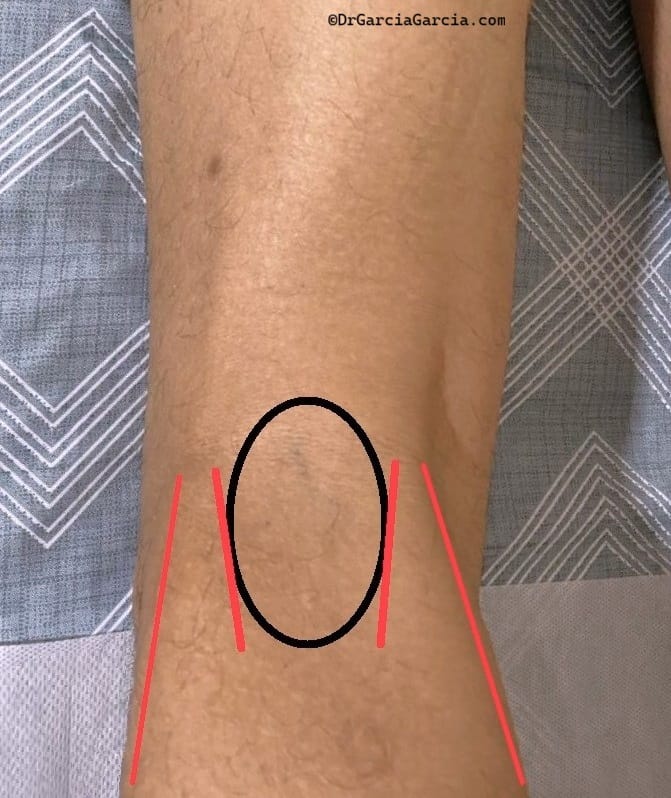 Vista posterior del hueco poplíteo; bordes tendinosos del gastrocnemio