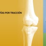 Vista posterior de la rodilla mostrando el fémur distal y la tibia proximal en dos modelos óseos a color, resaltando la articulación femorotibial y femoropatelar.