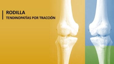 Vista posterior de la rodilla mostrando el fémur distal y la tibia proximal en dos modelos óseos a color, resaltando la articulación femorotibial y femoropatelar.