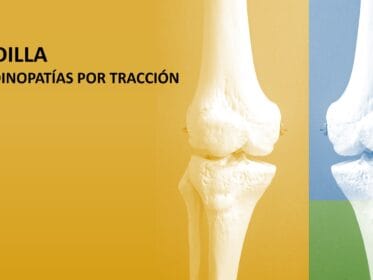 Vista posterior de la rodilla mostrando el fémur distal y la tibia proximal en dos modelos óseos a color, resaltando la articulación femorotibial y femoropatelar.