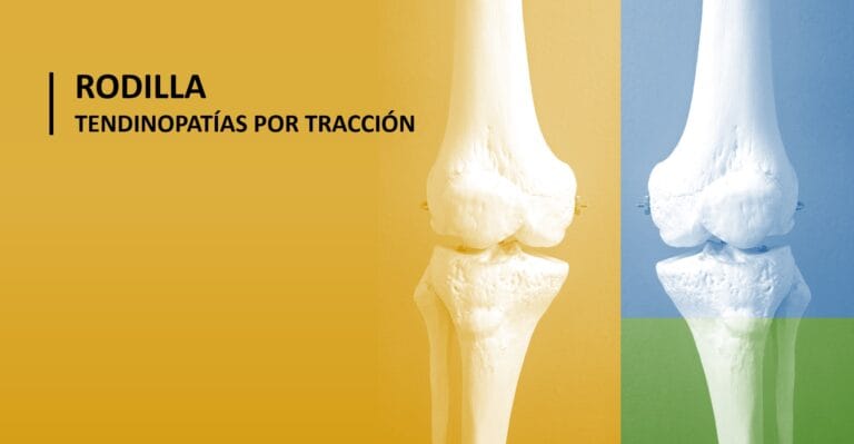 Vista posterior de la rodilla mostrando el fémur distal y la tibia proximal en dos modelos óseos a color, resaltando la articulación femorotibial y femoropatelar.