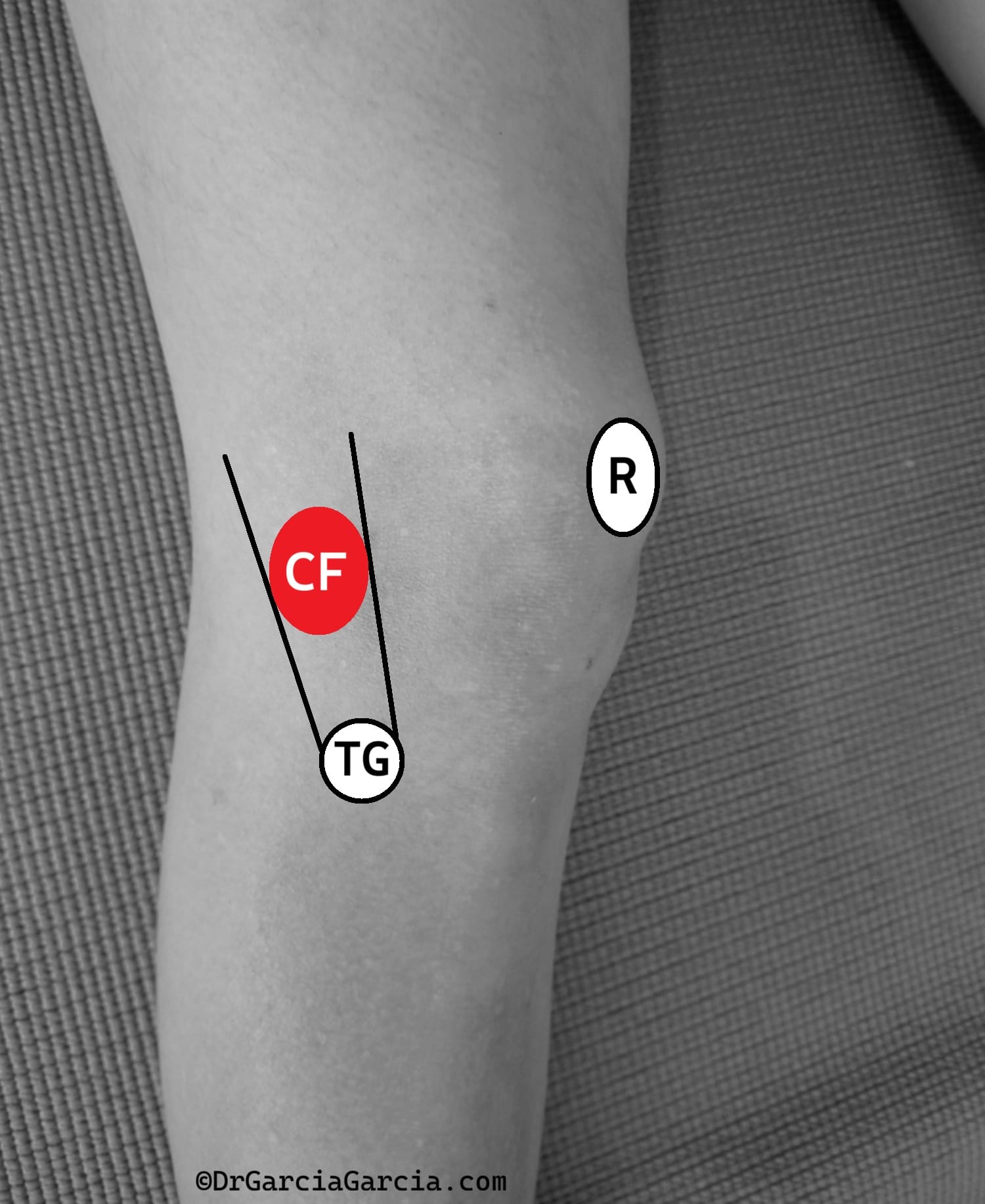 Zona de lesión y dolor de la cintilla iliotibial en la región lateral del cóndilo femoral