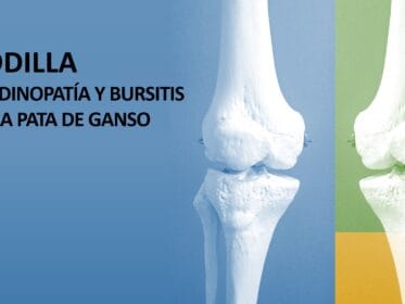 Banner sobre tendinopatía y bursitis de la pata de ganso con modelos anatómicos de rodilla.