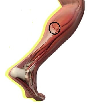 Figura 1b. Anatomía de la lesión muscular en gemelos