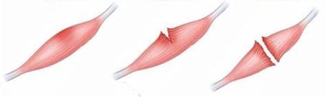 Figura 2. Grados de desgarro muscular