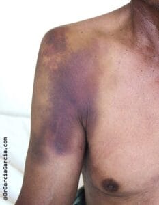 Hematoma amplio en hombro y brazo superior asociado con lesión muscular o contusión deportiva.