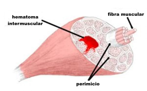Figura 3b. Hematoma intramuscular