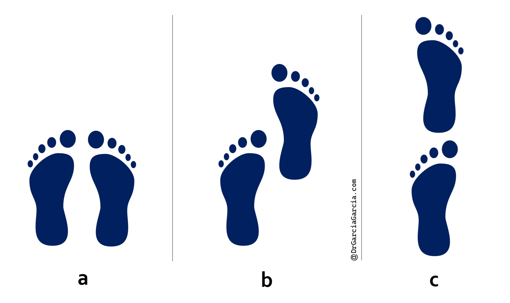 Figura 4. Prueba de equilibrio con posiciones de pies juntos, semitándem y tándem.