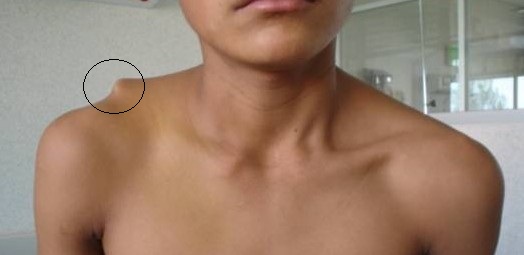 Fotografía clínica del hombro con área acromioclavicular señalada.