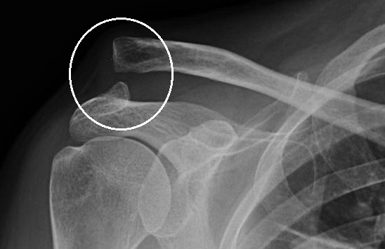 Radiografía de la articulación acromioclavicular con región señalada
