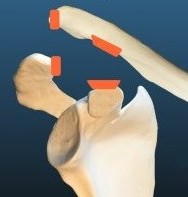 Luxación acromioclavicular inestable con rotura ligamentaria y desplazamiento de la clavícula.