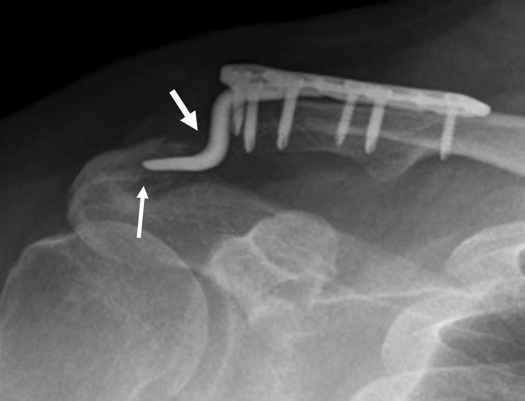 Radiografía de una placa de gancho con osteólisis acromial y pérdida de la reducción señaladas mediante flechas.