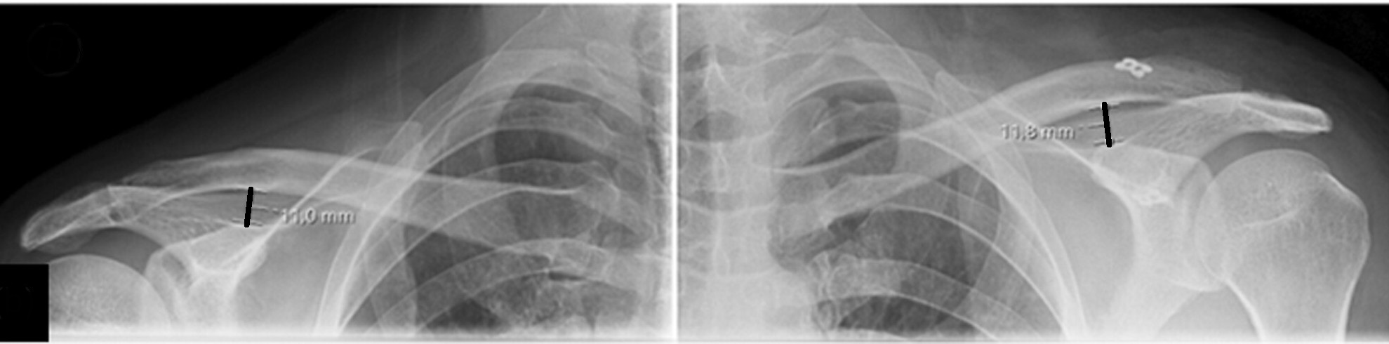 Medición comparativa de la distancia coracoclavicular