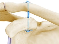Esquema de reconstrucción coracoclavicular de un haz mediante sistema TightRope.