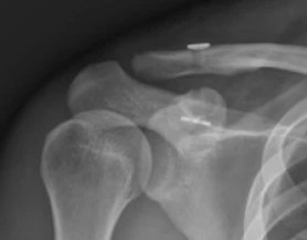 Radiografía de reconstrucción coracoclavicular con botones de sutura en clavícula y coracoides.