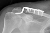 Fijación de la articulación acromioclavicular con placa de gancho