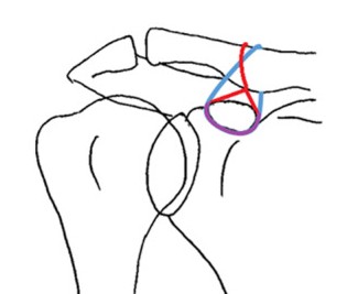 Esquema de reparación coracoclavicular con sutura sintética doble, en ocho y en caja.