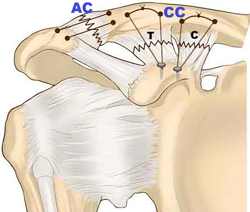 Esquema de reconstrucción acromioclavicular y coracoclavicular con suturas transóseas.