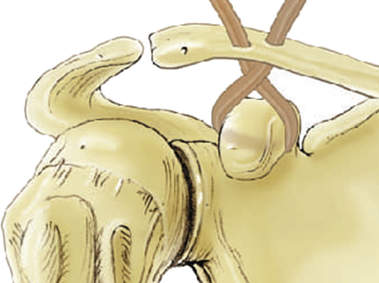 Esquema de reconstrucción coracoclavicular de doble haz con injerto tendinoso.