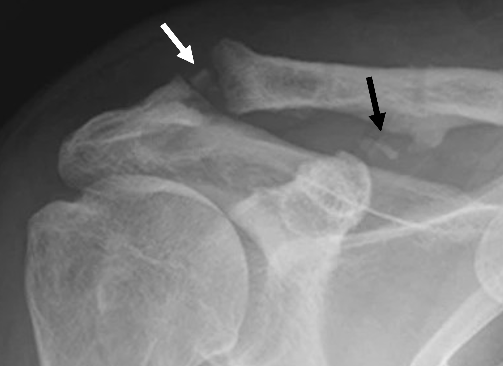 Artrosis acromioclavicular y osificación coracoclavicular