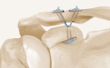 Esquema de reconstrucción coracoclavicular de doble haz mediante sistema TightRope.