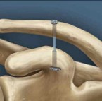 Reconstrucción coracoclavicular con sistema suspensorio TightRope
