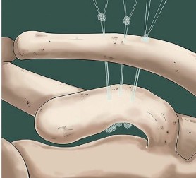 Reconstrucción coracoclavicular con múltiples suturas