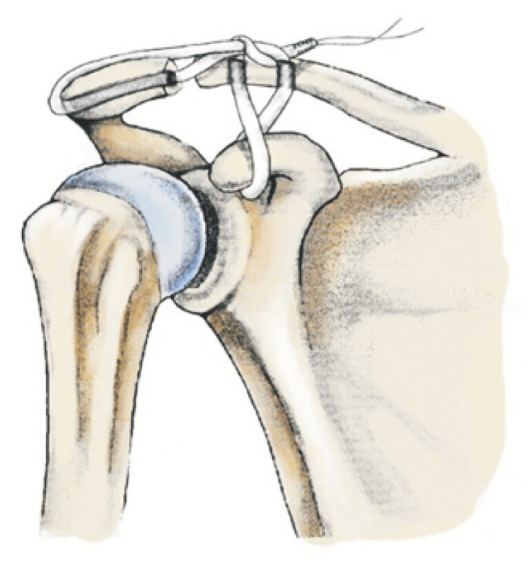 Reconstrucción anatómica acromioclavicular con injerto tendinoso