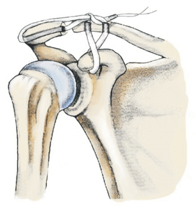Reconstrucción anatómica acromioclavicular con injerto tendinoso