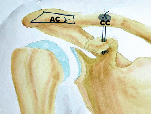 Reconstrucción anatómica acromioclavicular con material sintético
